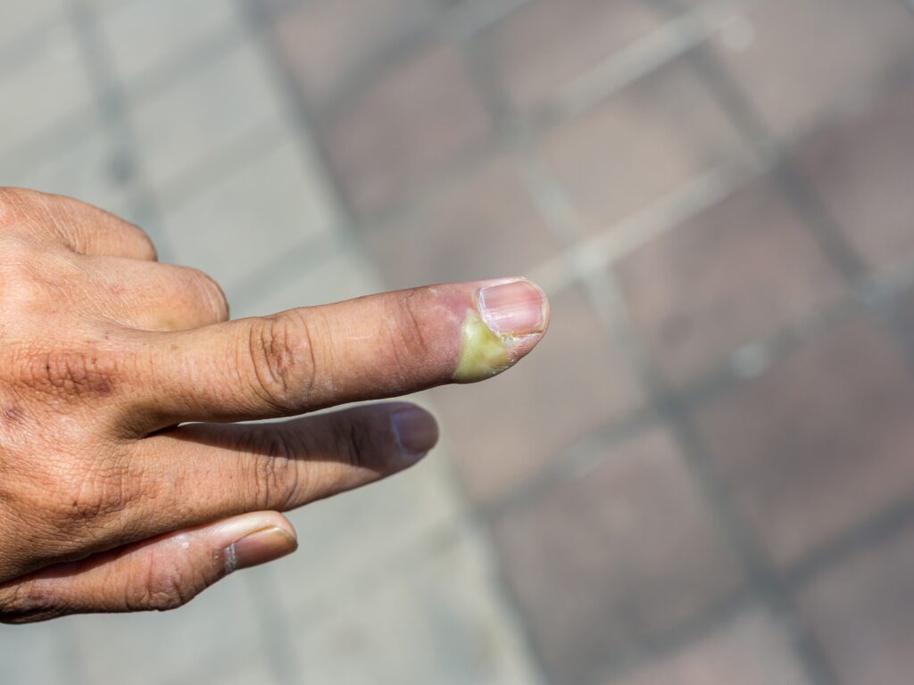 Qué significa ser una persona que se come las uñas y cómo dejarlo